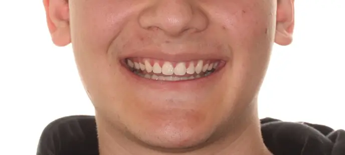 After Facial Smiling Photo