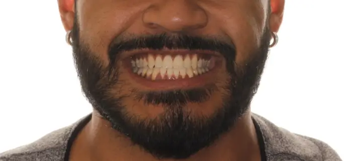 After Facial Smiling Photo