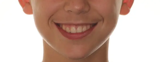 After Facial Smiling Photo