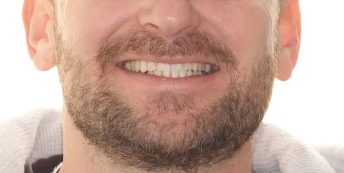 After Facial Smiling Photo