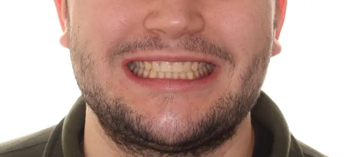 After Facial Smiling Photo