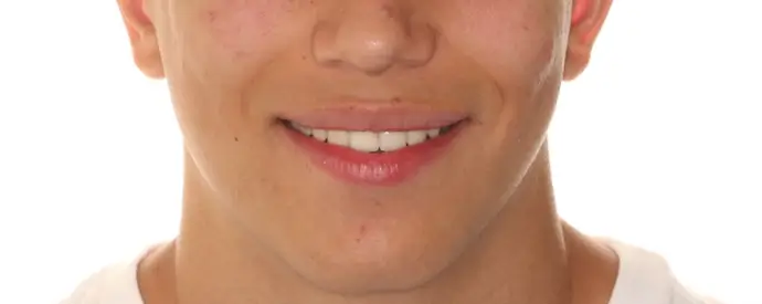 After Facial Smiling Photo