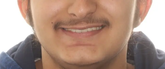 After Facial Smiling Photo
