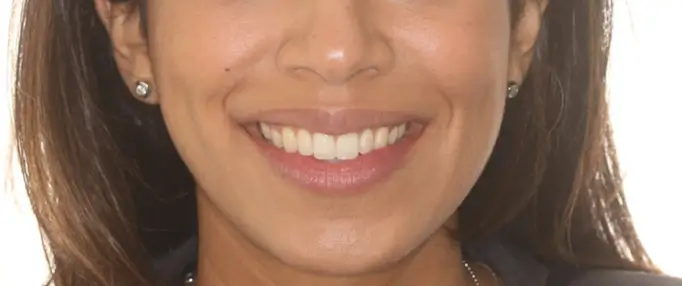 After Facial Smiling Photo