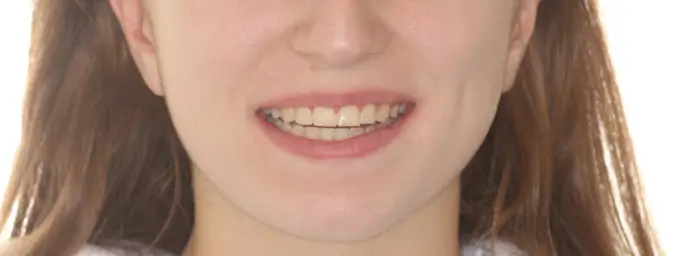 After Facial Smiling Photo
