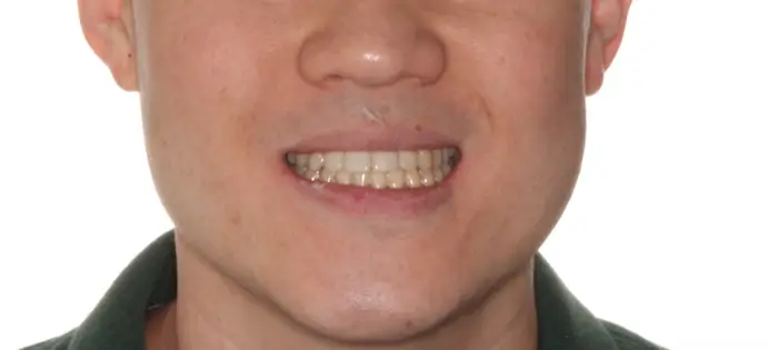 After Facial Smiling Photo