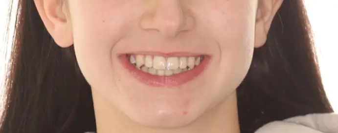 After Facial Smiling Photo