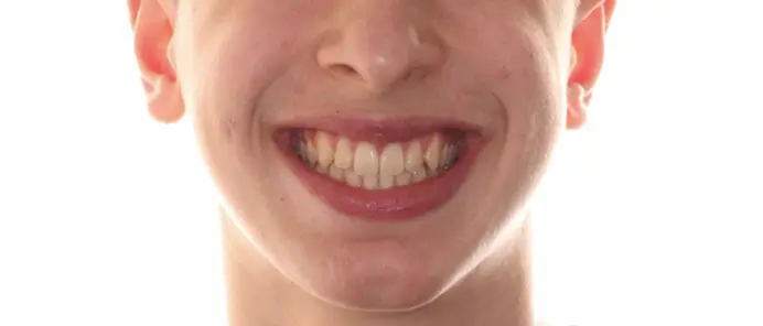 After Facial Smiling Photo