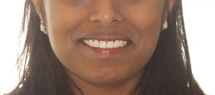 After Facial Smiling Photo