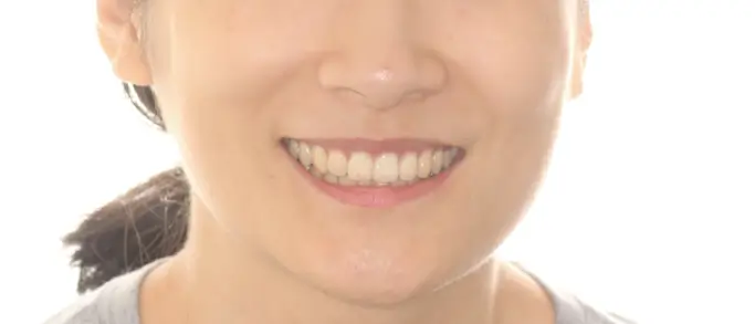 After Facial Smiling Photo