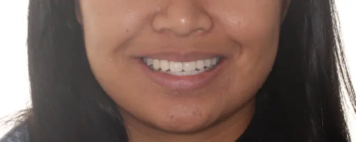 After Facial Smiling Photo