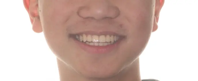 After Facial Smiling Photo