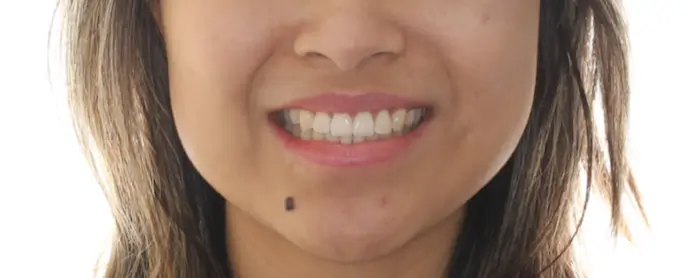 After Facial Smiling Photo