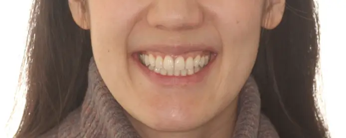 After Facial Smiling Photo