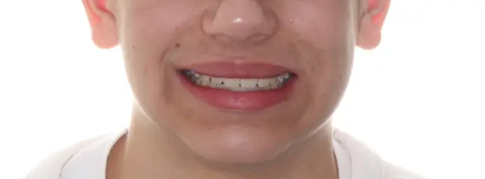 After Facial Smiling Photo