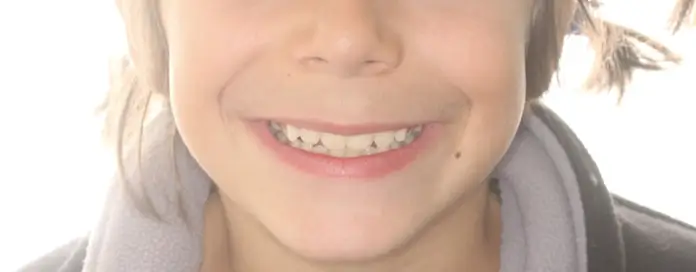 After Facial Smiling Photo