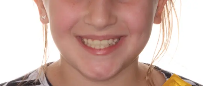 After Facial Smiling Photo
