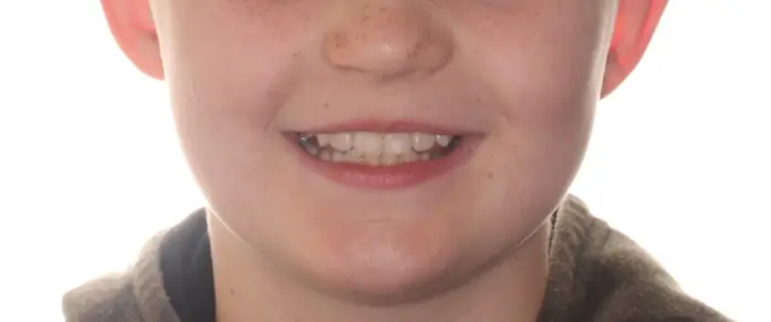 After Facial Smiling Photo