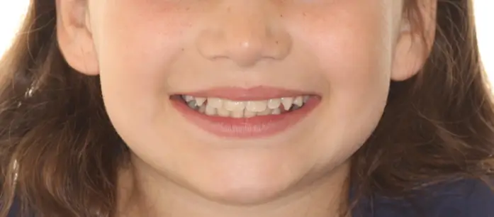 After Facial Smiling Photo