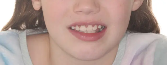 After Facial Smiling Photo