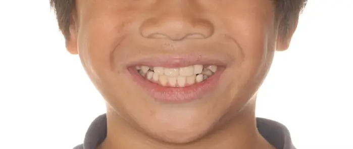 After Facial Smiling Photo