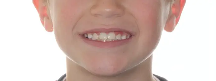 After Facial Smiling Photo