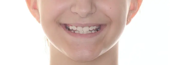 After Facial Smiling Photo