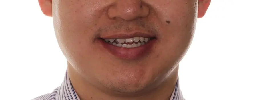 Before Facial Smiling Photo