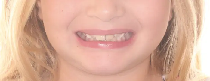 Before Facial Smiling Photo