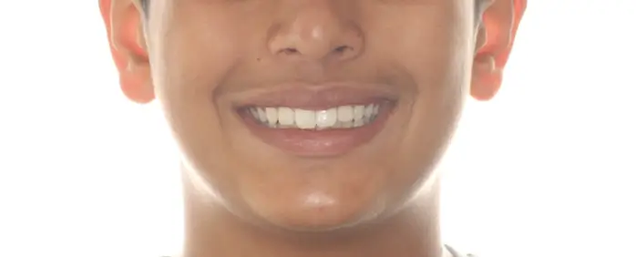 Before Facial Smiling Photo
