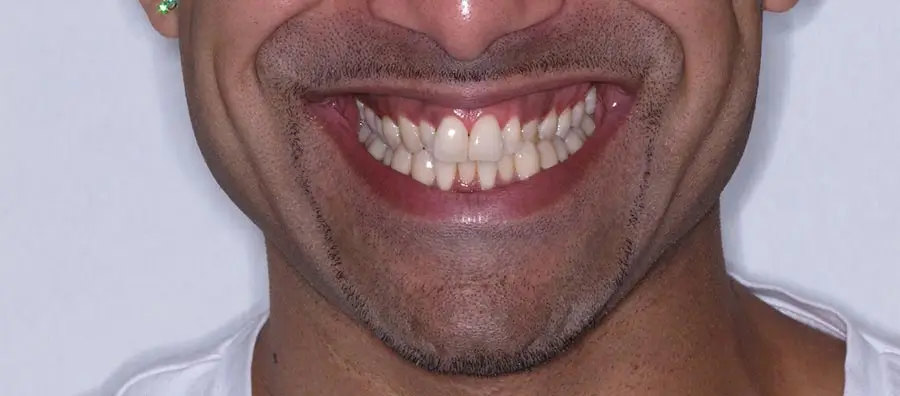 Before Facial Smiling Photo