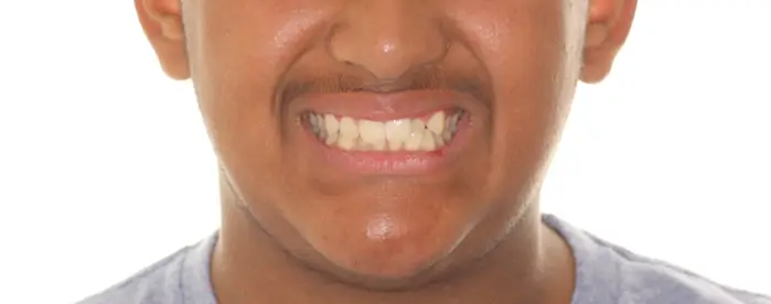 Before Facial Smiling Photo
