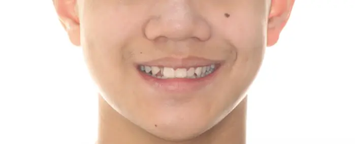 Before Facial Smiling Photo