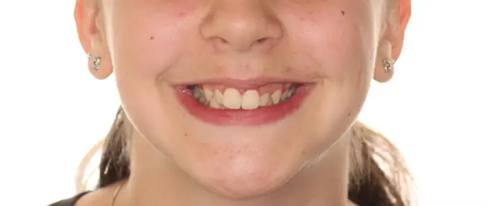 Before Facial Smiling Photo