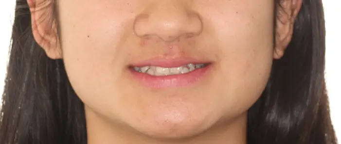 Before Facial Smiling Photo