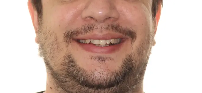 Before Facial Smiling Photo