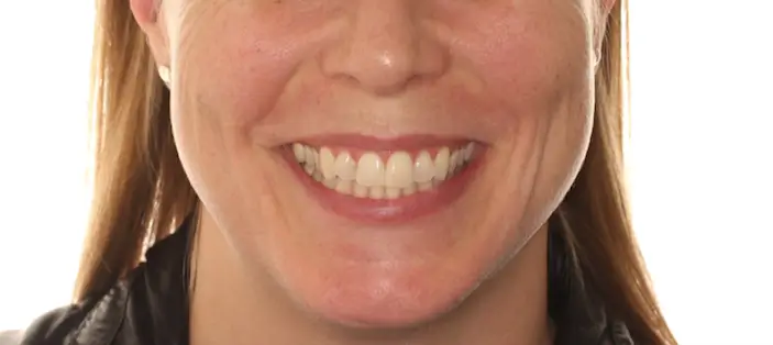 Before Facial Smiling Photo