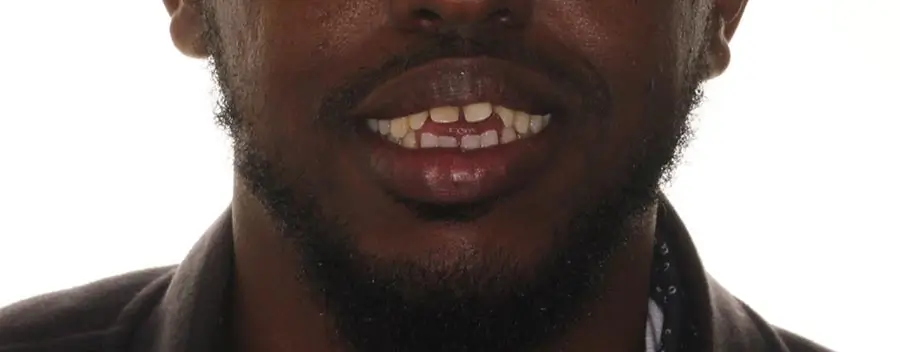 Before Facial Smiling Photo