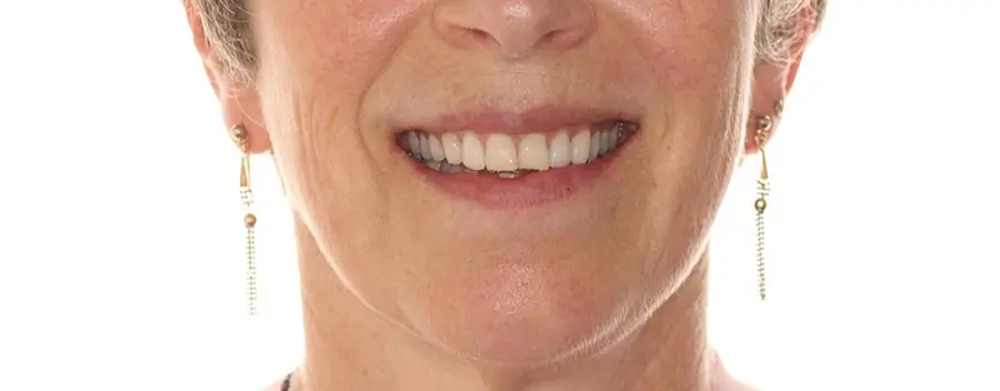 Before Facial Smiling Photo