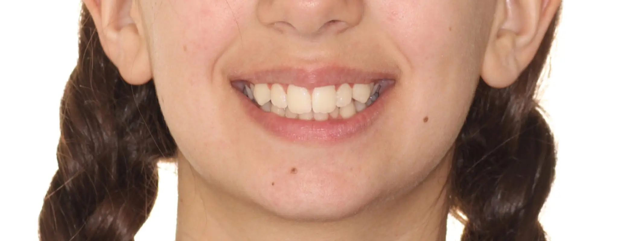 Before Facial Smiling Photo