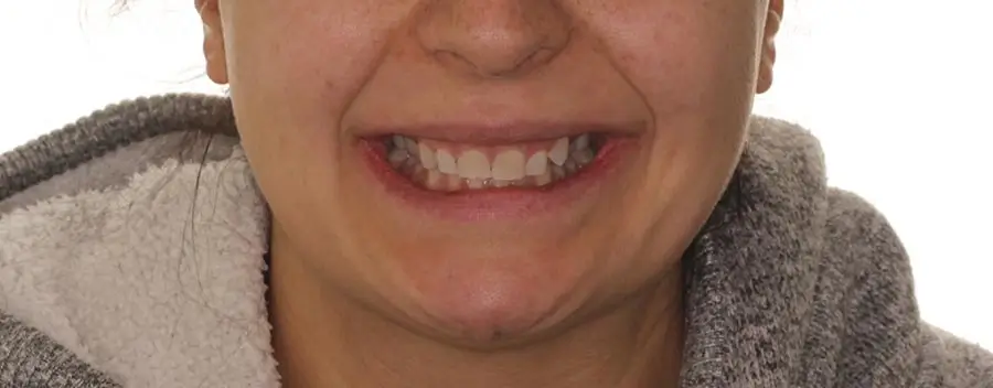 Before Facial Smiling Photo