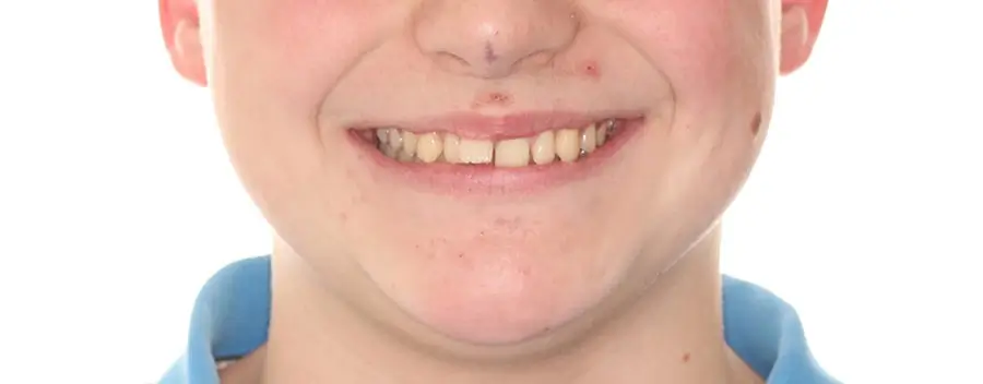Before Facial Smiling Photo