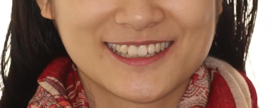 Before Facial Smiling Photo