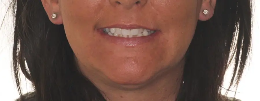 Before Facial Smiling Photo