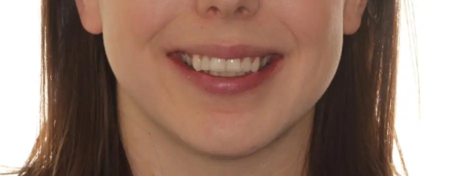 Before Facial Smiling Photo
