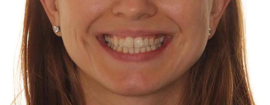Before Facial Smiling Photo