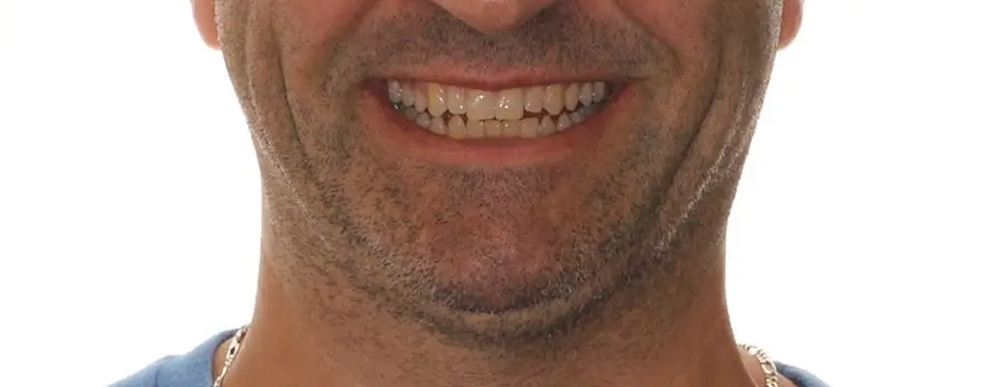 Before Facial Smiling Photo
