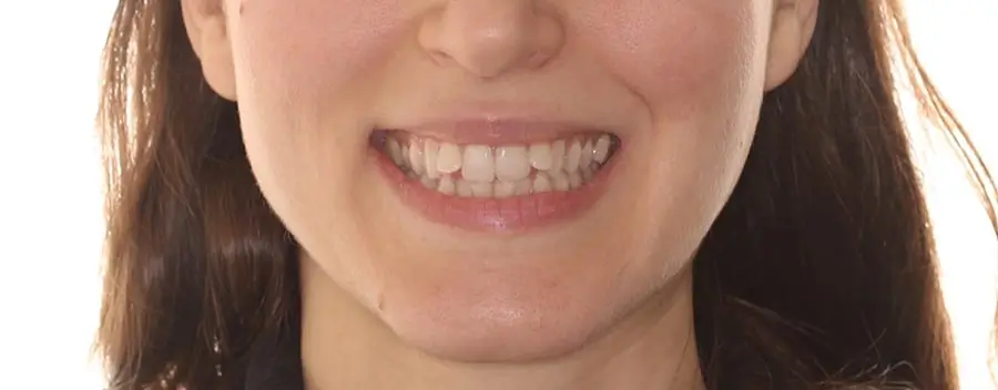 Before Facial Smiling Photo
