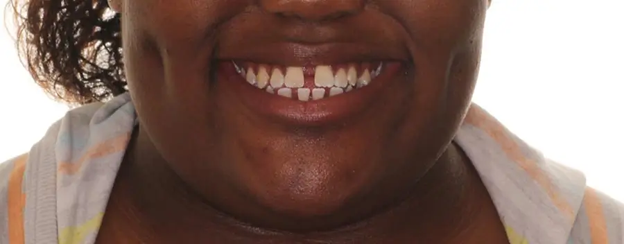Before Facial Smiling Photo
