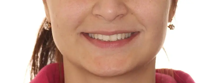 Before Facial Smiling Photo